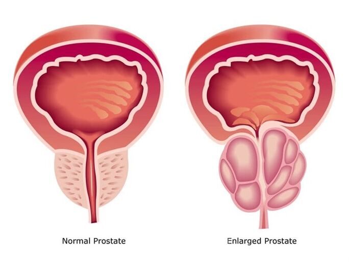 Prostovit normalizes prostate work and size