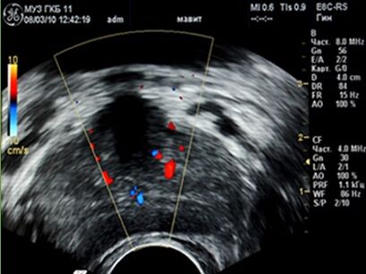 Ultrasound shows prostate inflammation