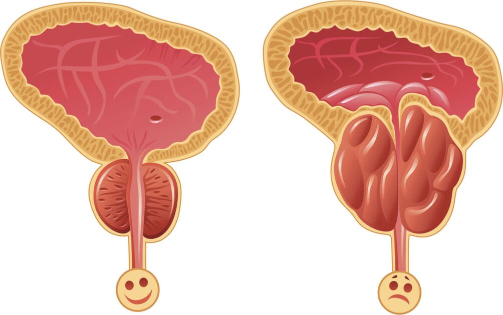 prostatitis