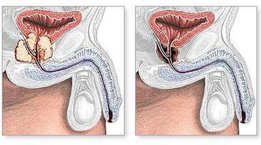 Before and after treatment with chronic prostatitis
