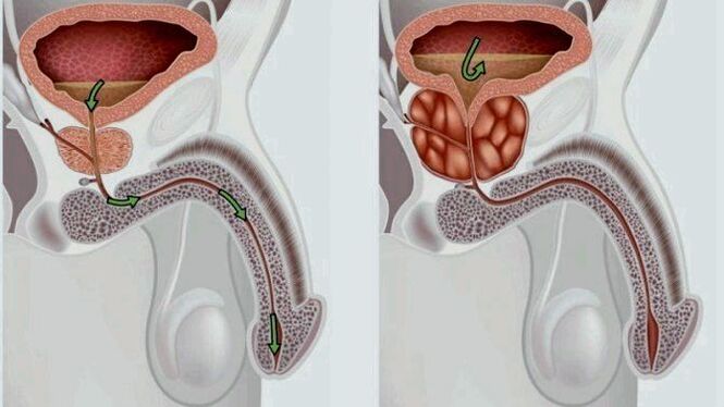 A healthy and inflamed prostate (with prostatitis)