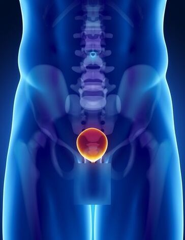 Inflammation of the prostate in men with prostatitis