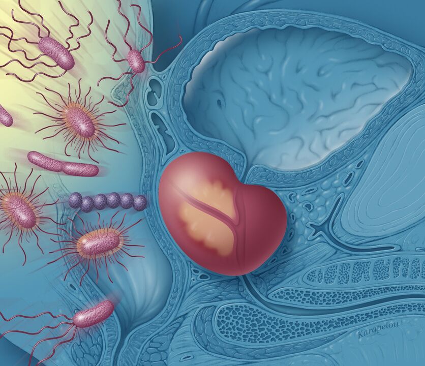 Male prostatitis