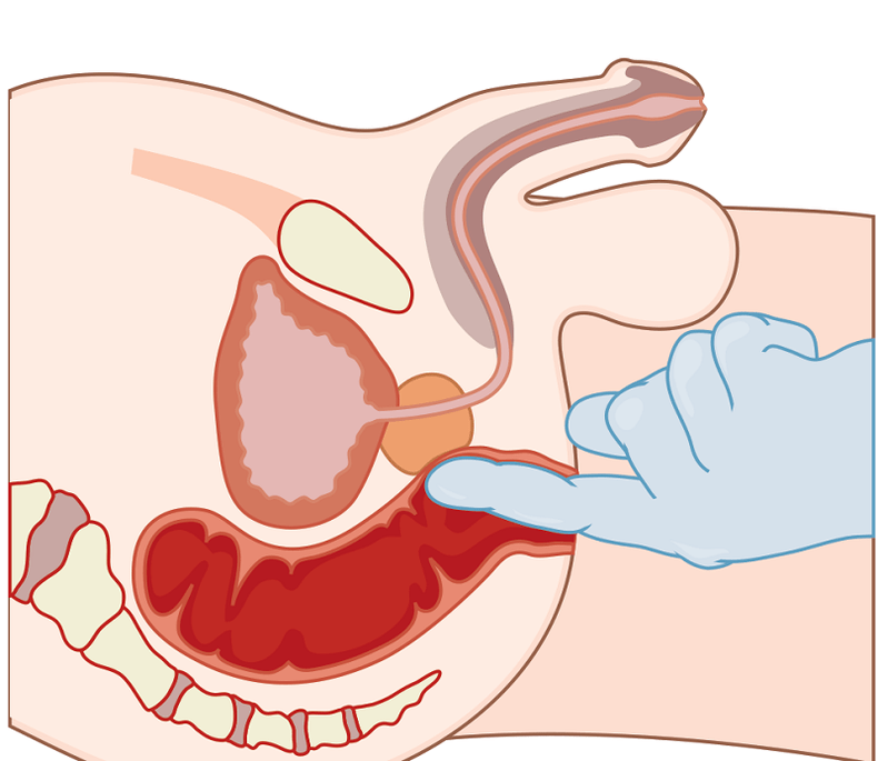 Prostate massage for prostatitis