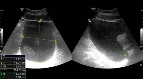 Signs of prostatitis in ultrasound